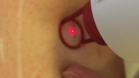 Laser para vasinho